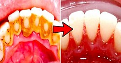 Before and after our Professional Teeth cleaning