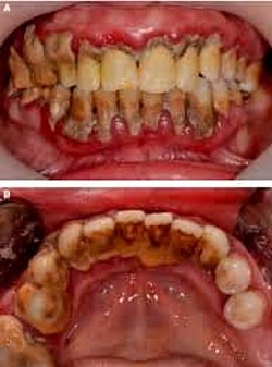 A neglected mouth.