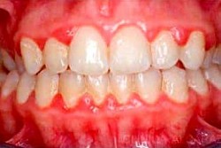 Infected gum