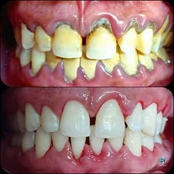 This ☝️ plaque and Calculus are capable of removing your teeth