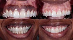 Maintain a healthy gum,stop using toothpicks but get Dental floss